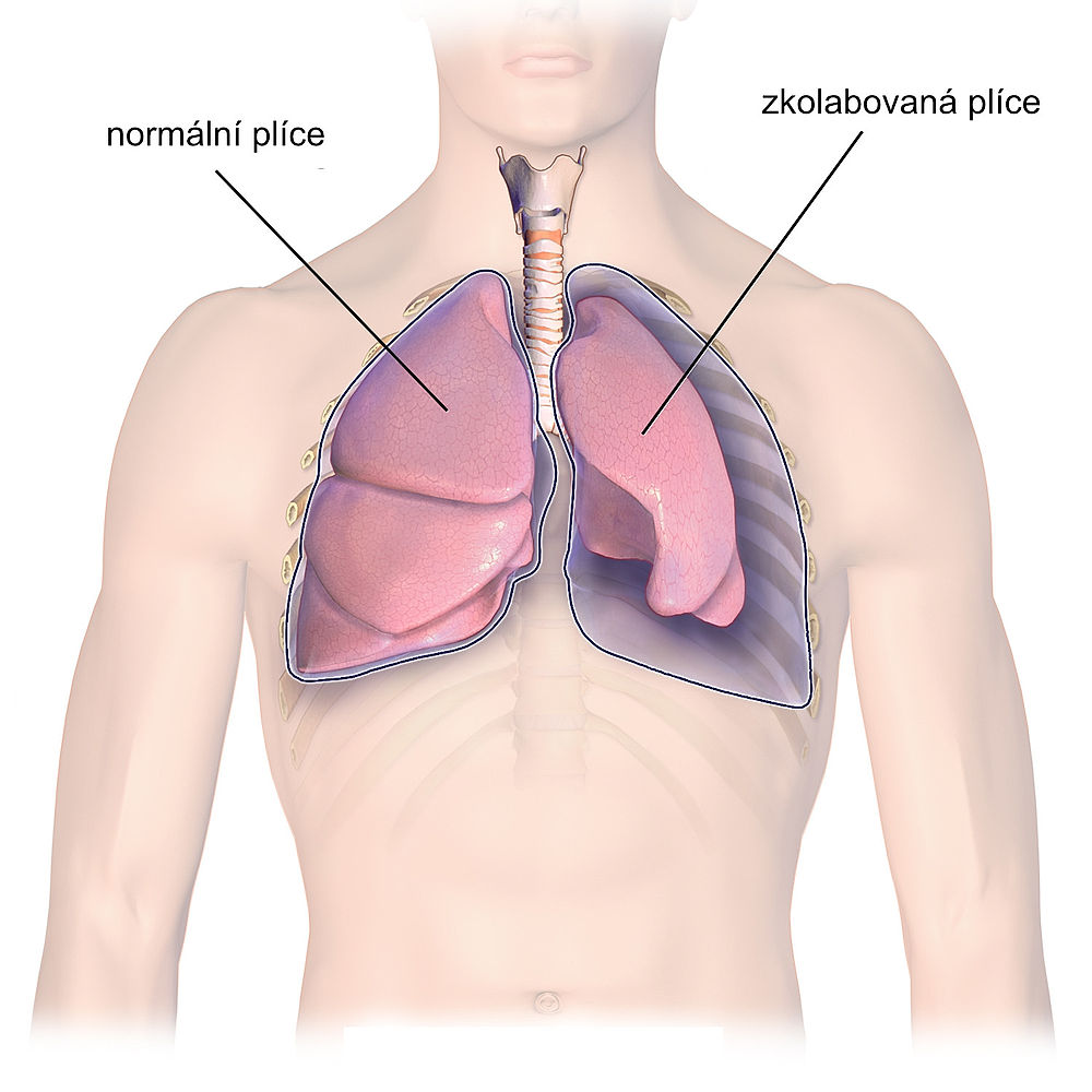 ilustrace pneumotoraxu