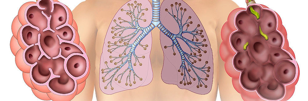 Jak se projevuje rozedma plic?