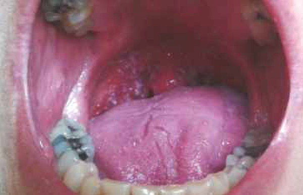 kvasinková infekce – bělavá drobná ložiska na zarudlé sliznici hrdla