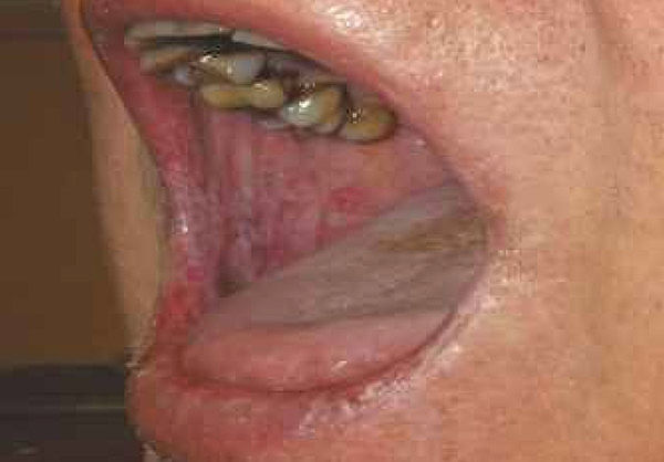 postižení sliznice rtů a tváří při reakci štěpu proti hostiteli (GVHD) po transplantaci kostní dřeně