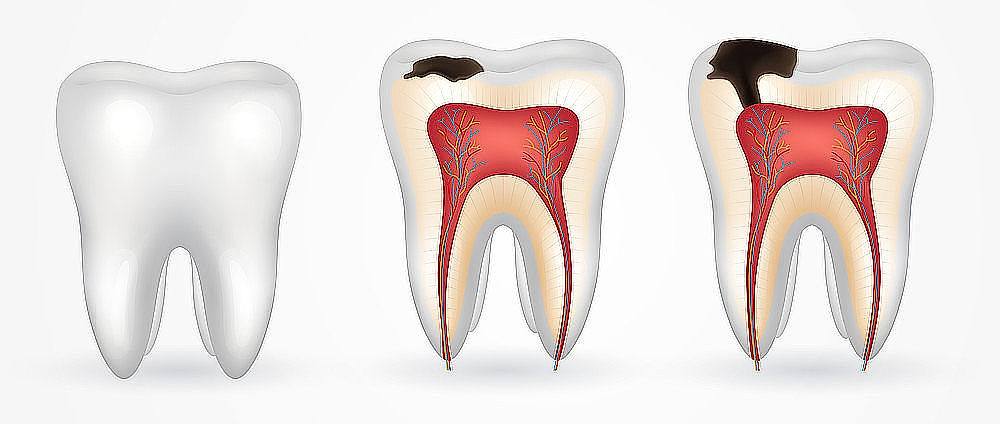 obrázek 3 k článku Zubní kaz: co to je a jak mu předcházet (snadné čtení)