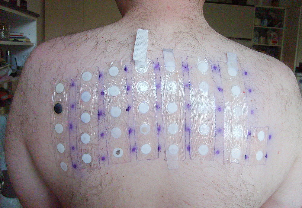 obrázek 1 k článku Alergie: diagnóza