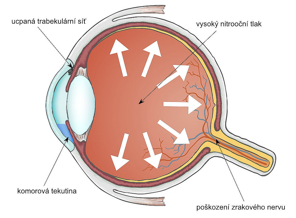 vysoký oční tlak příznaky