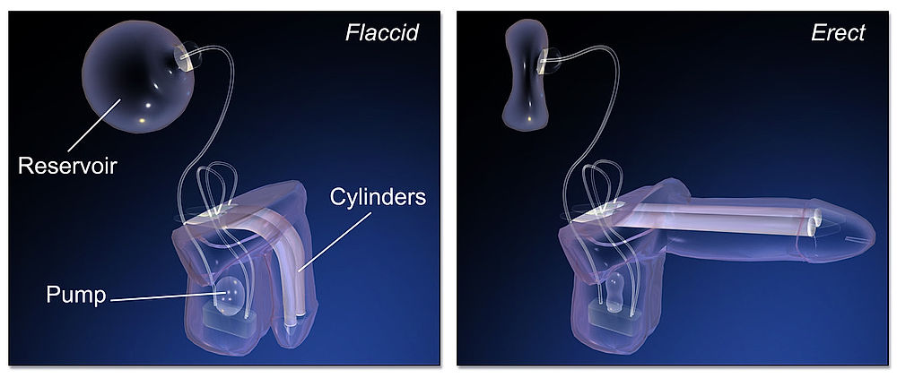 obrázek 1 k článku Erektilní dysfunkce (poruchy erekce, impotence)