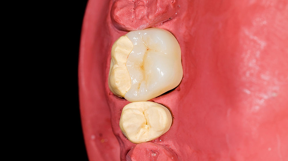 Keramické onlaye a overlaye