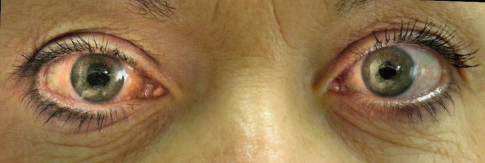 Povišeni očni tlak i glaukom – otkrijte pravovremeno tihog ubojicu vida